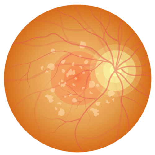 dry macular degeneration