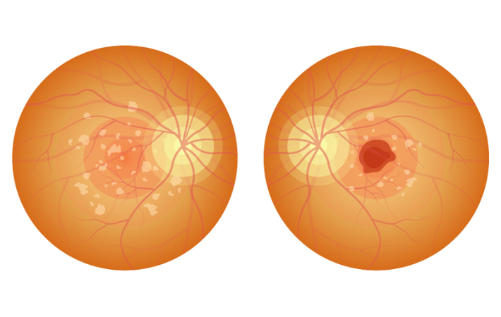 dry vs wet macular degeneration blog post 1