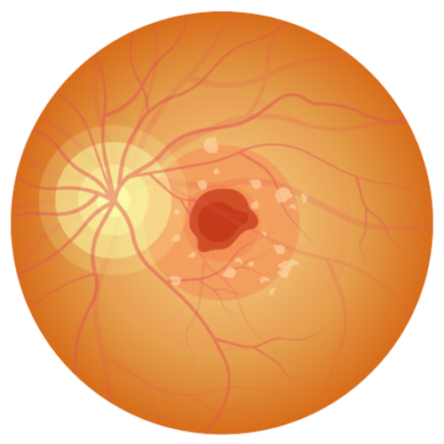 wet macular degeneration